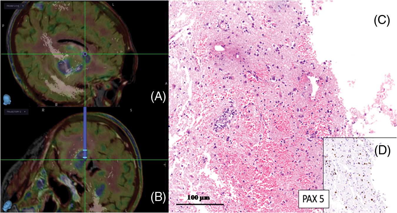 Oncologie Free Full Text The Neurosurgical Challenge Of Primary