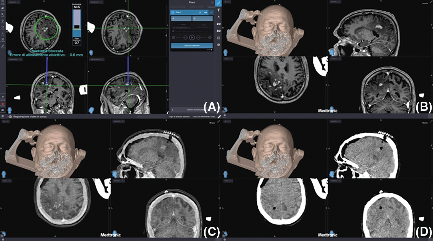 Oncologie Free Full Text The Neurosurgical Challenge Of Primary