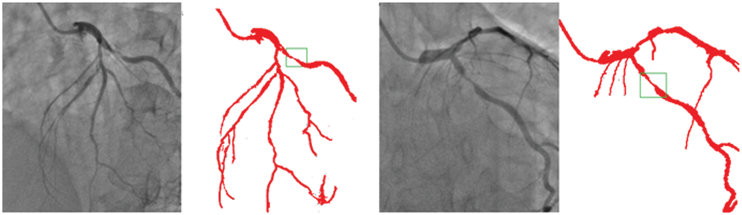 CMES | Free Full-Text | Vessels Segmentation in Angiograms Using ...