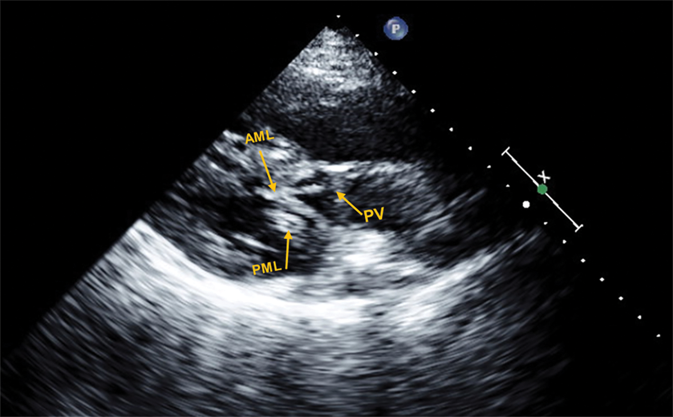 CHD | Free Full-Text | Anatomic Correlates of Mitral Systolic Anterior ...