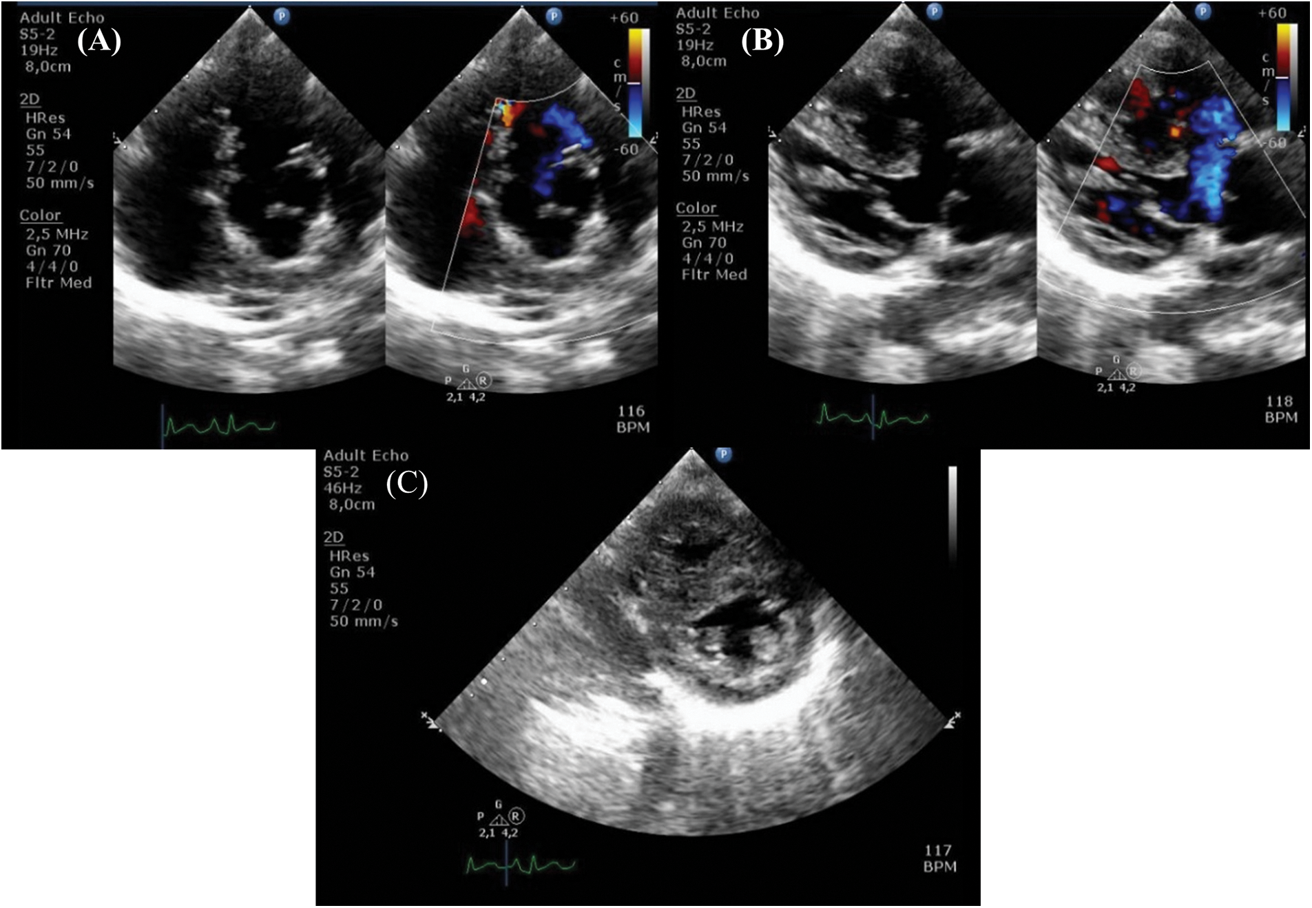 CHD | Free Full-Text | Pulmonary Hypertension Crisis in Patient with ...