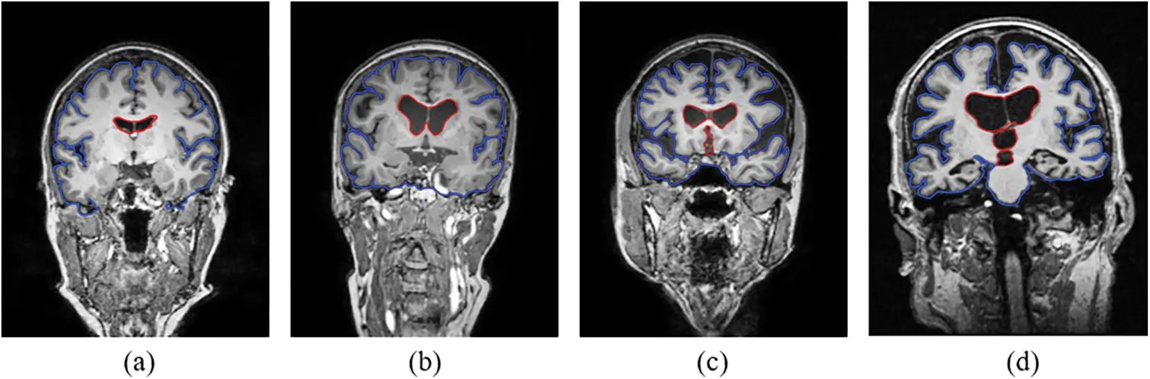 CMC | Free Full-Text | Alzheimer’s Disease Stage Classification Using a ...