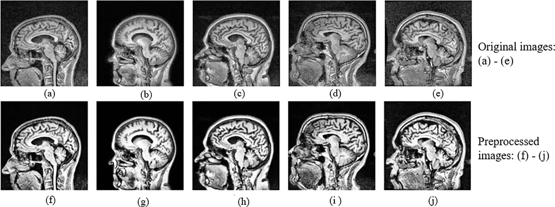 CMC | Free Full-Text | Alzheimer’s Disease Stage Classification Using a ...