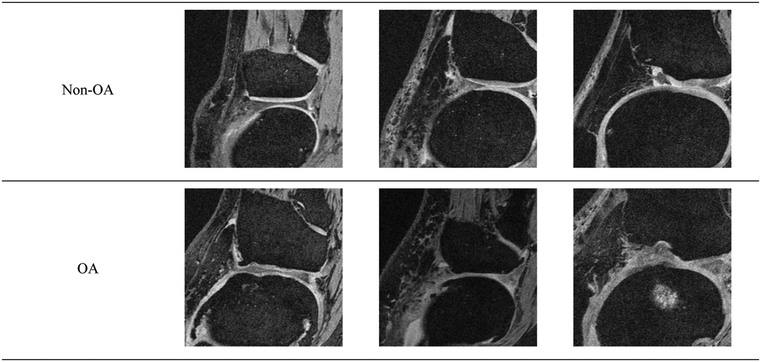 IASC Free FullText Detection Algorithm of Knee Osteoarthritis Based on Resonance