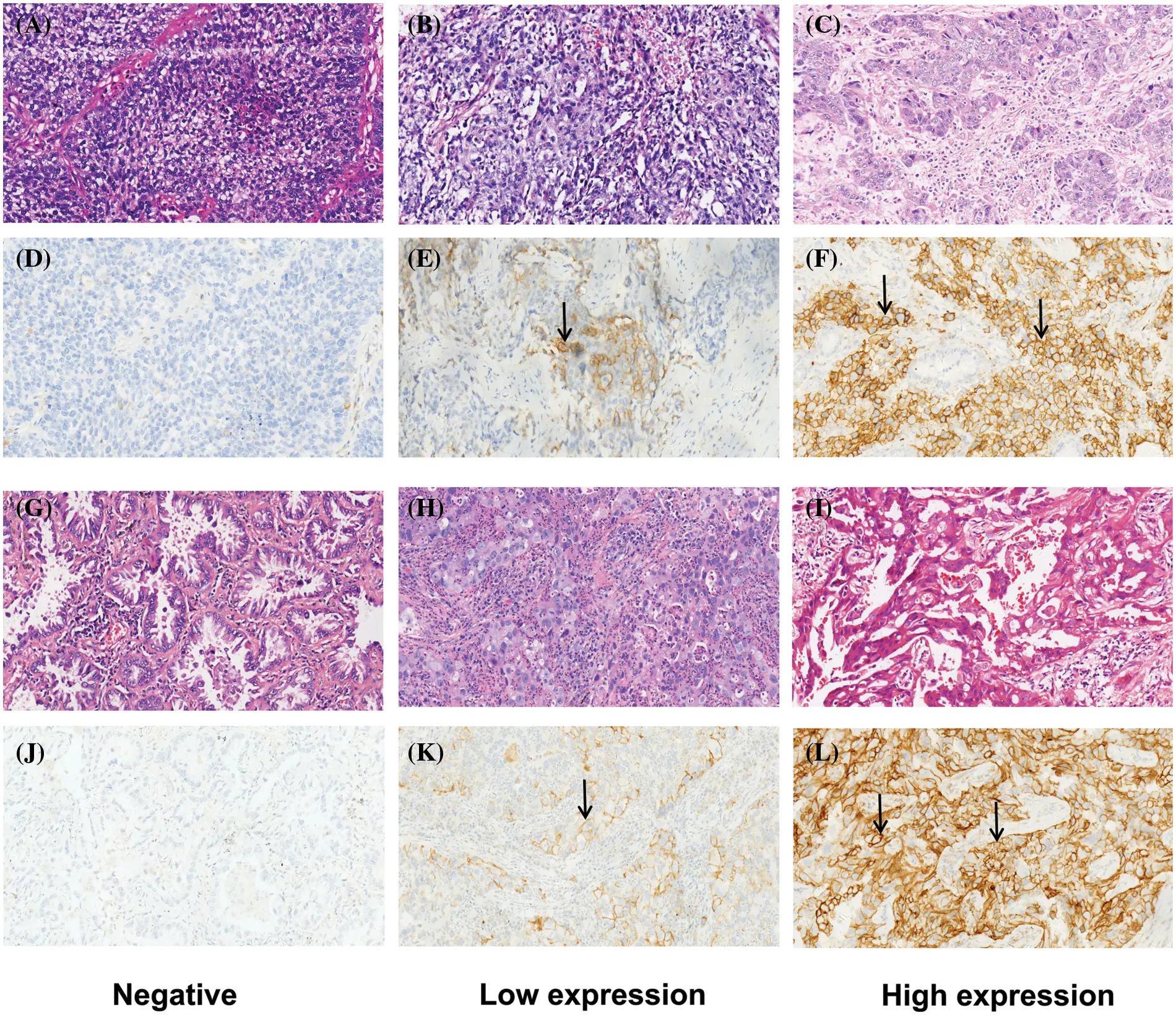 OR | Free Full-Text | High expression of PD-L1 mainly occurs in non ...