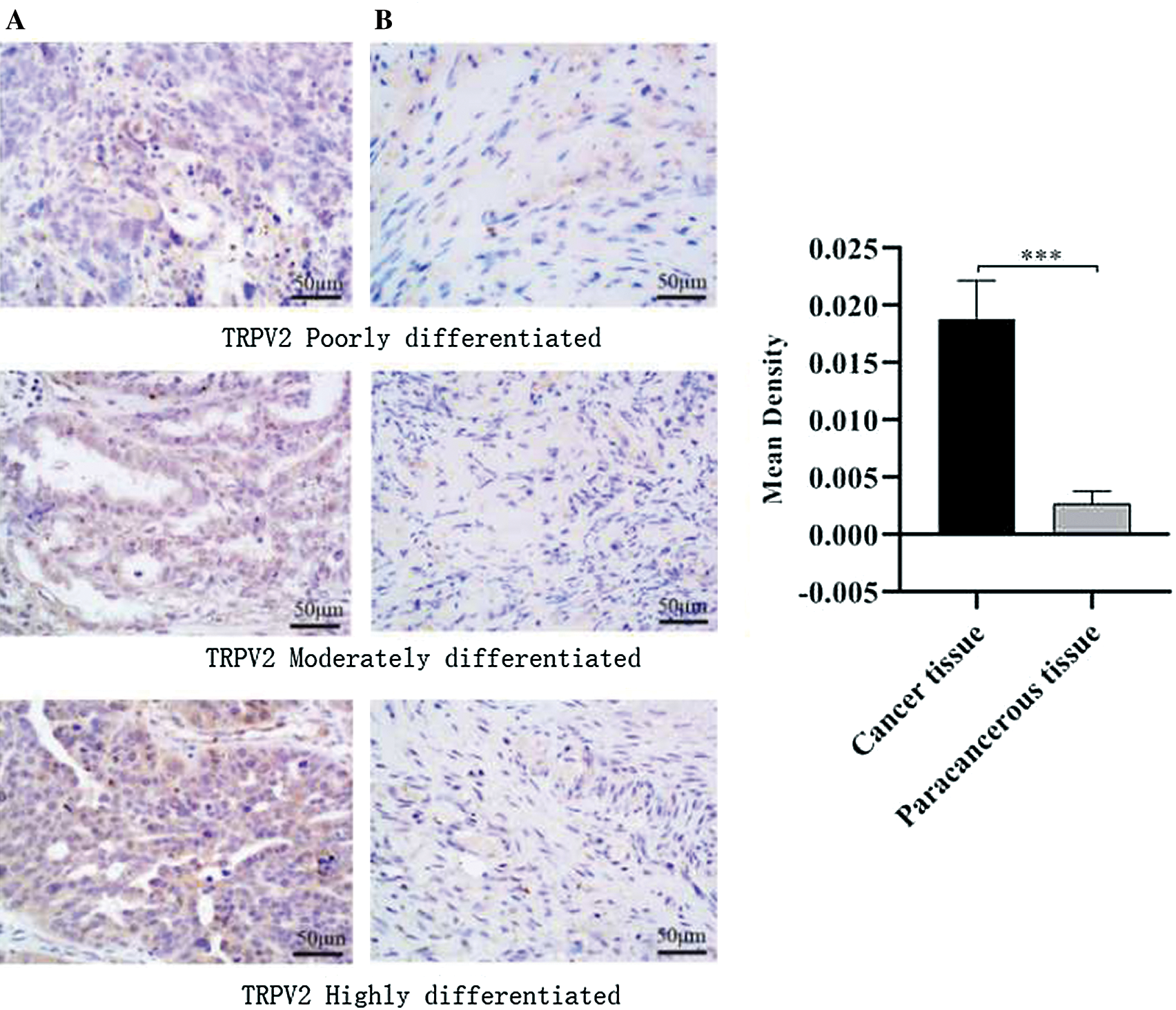 Study on the clinical significance of TRPV2 and MMP2 expressions in