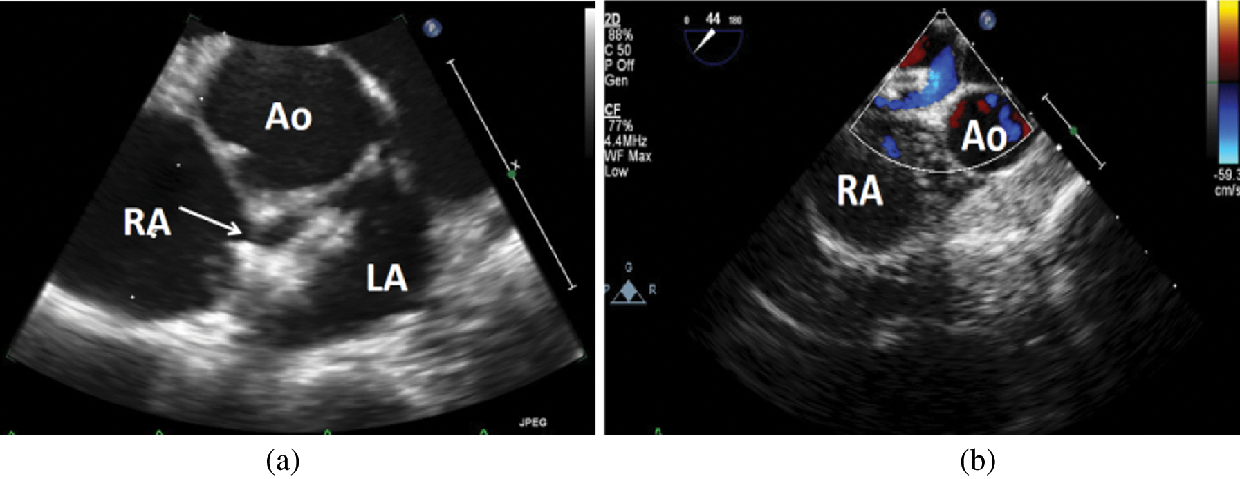 The ASD that Wouldn’t Go Away An Unusual Case of ASD Device Failure in