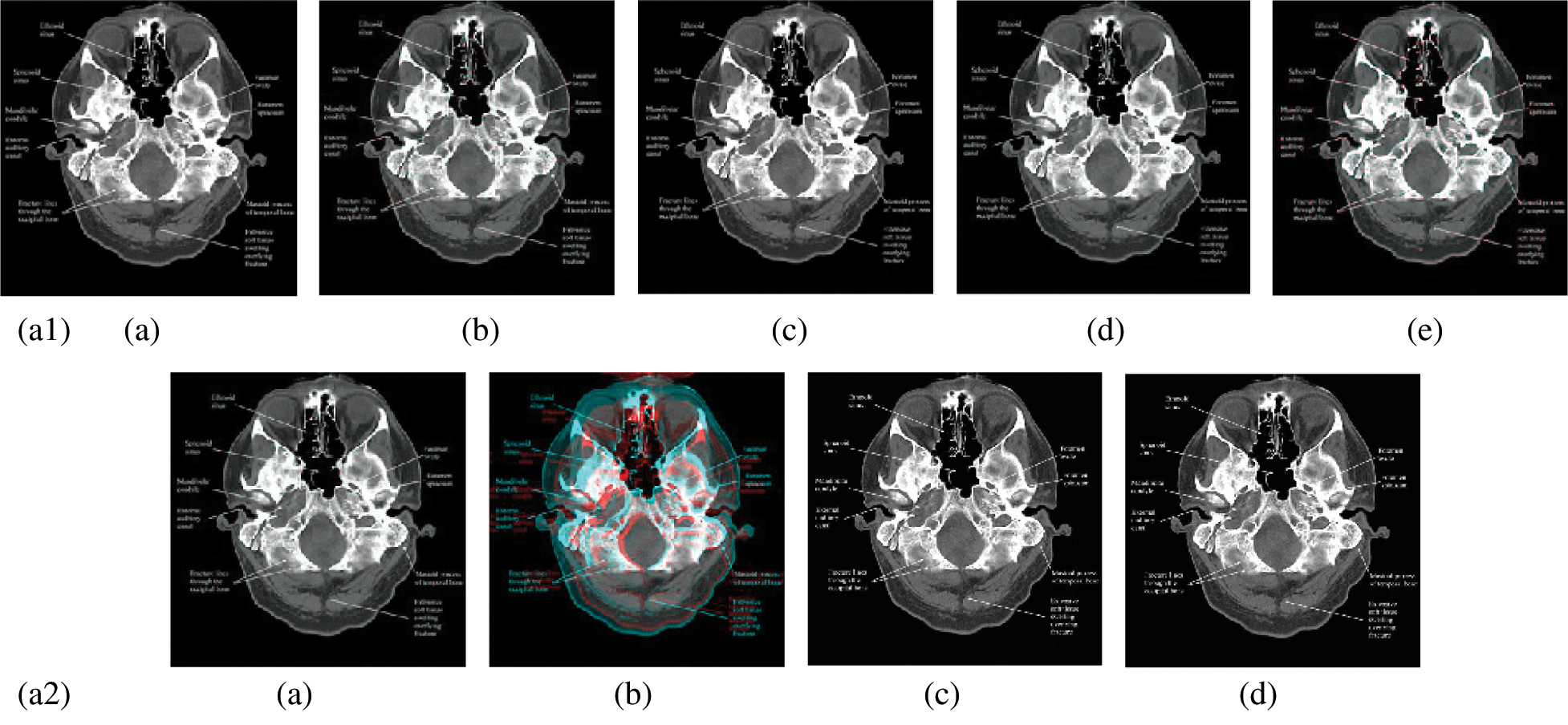 Medical Image Compression Based on Wavelets with Particle Swarm ...