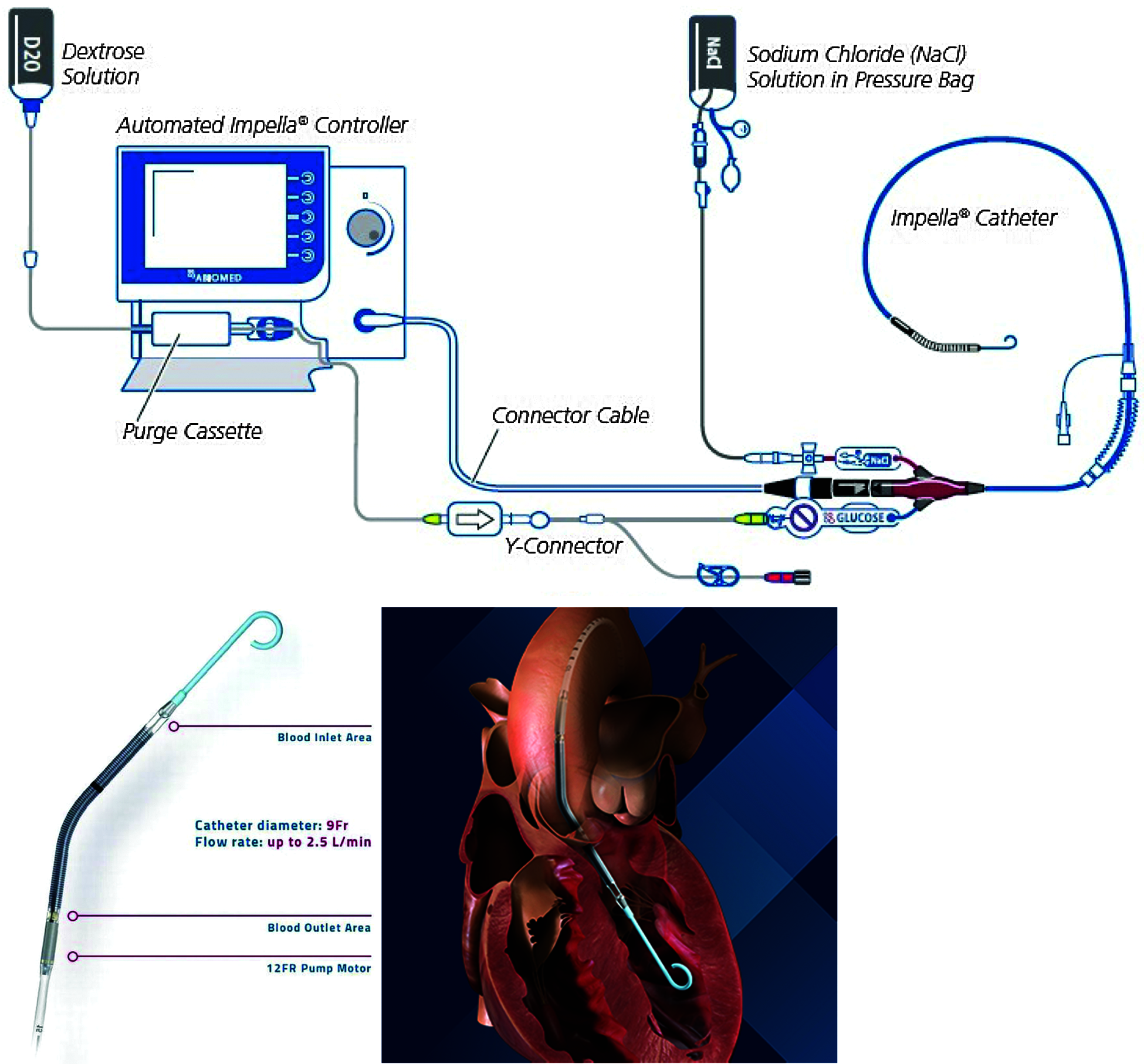 Use of Impella cardiac axial flow pump for cardiogenic shock (A newer