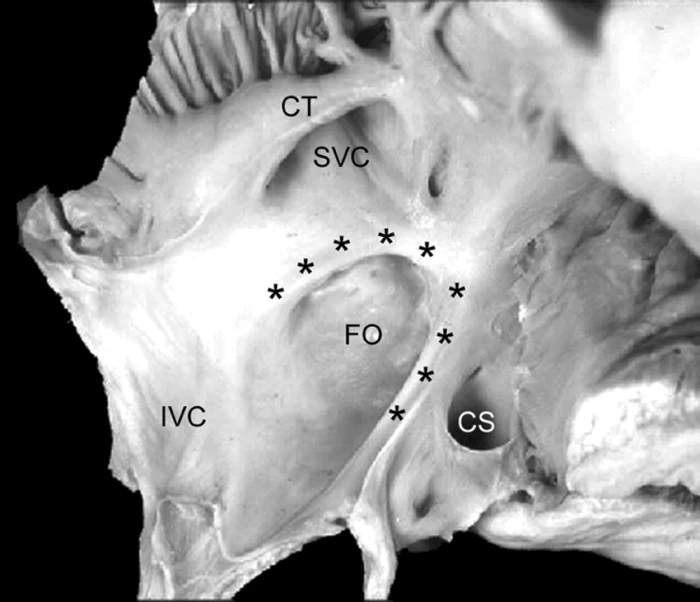 Limbus Fossa Ovalis