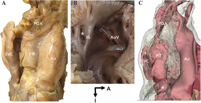 infundibulum heart