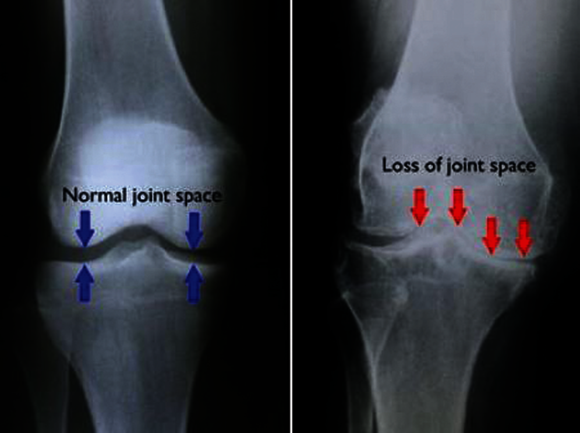 Automatic Detection and Classification of Human Knee Osteoarthritis ...