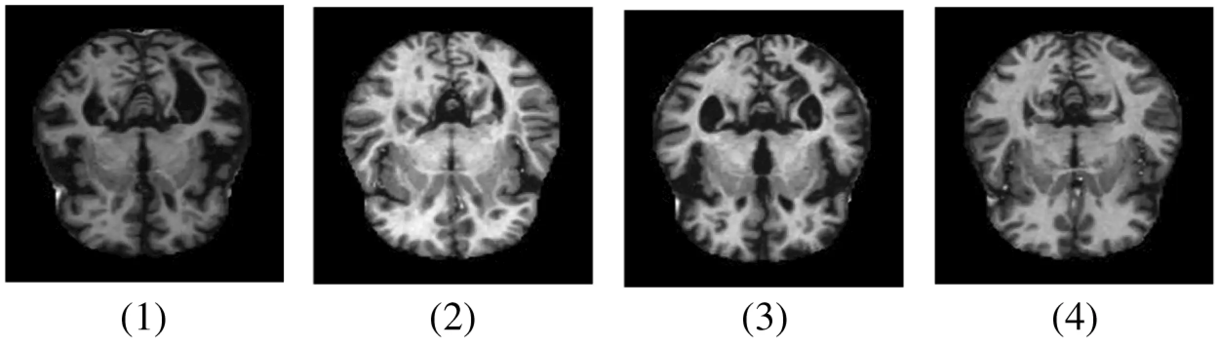 Alzheimer Disease Detection Empowered with Transfer Learning