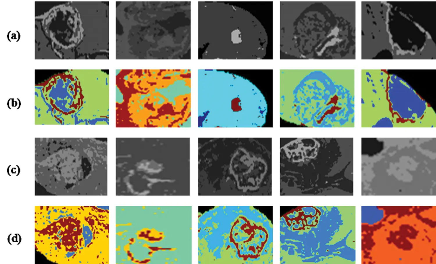 Brain Tumor Detection and Segmentation Using RCNN