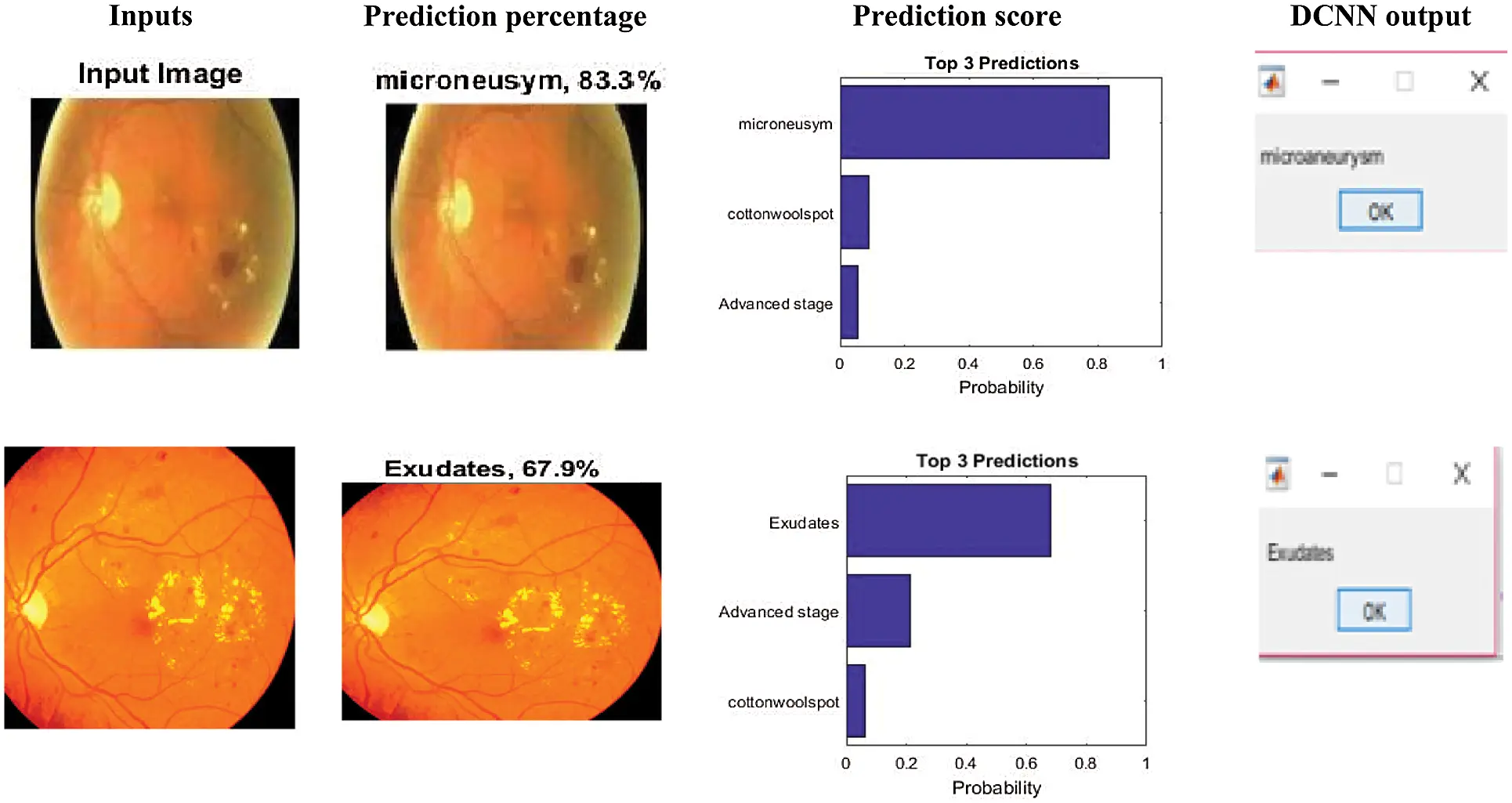 Detection and Classification of Diabetic Retinopathy Using DCNN and BSN ...