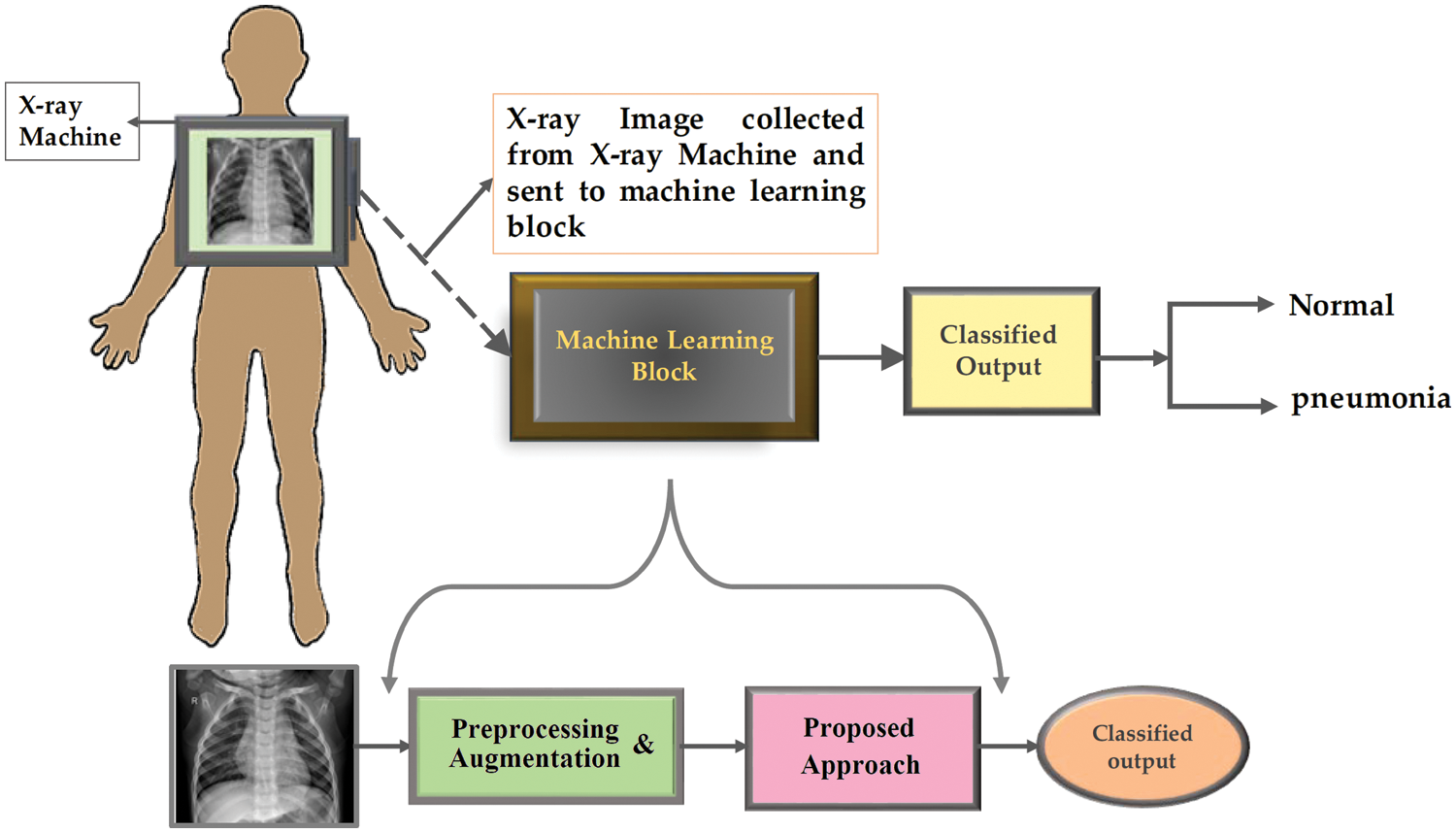 Transfer Learning for Chest X-rays Diagnosis Using Dipper Throated ...