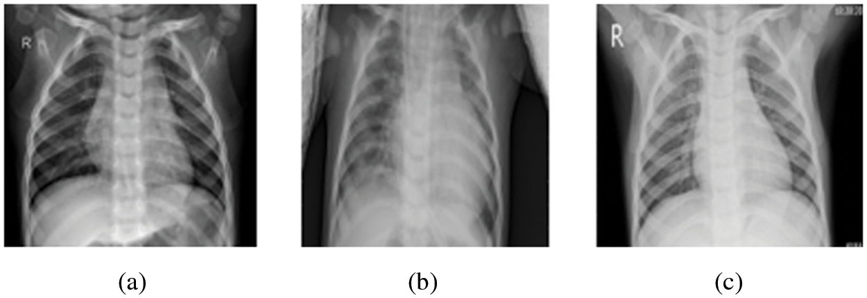 Transfer Learning for Chest X-rays Diagnosis Using Dipper Throated ...