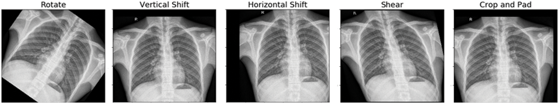 Transfer Learning for Chest X-rays Diagnosis Using Dipper Throated ...