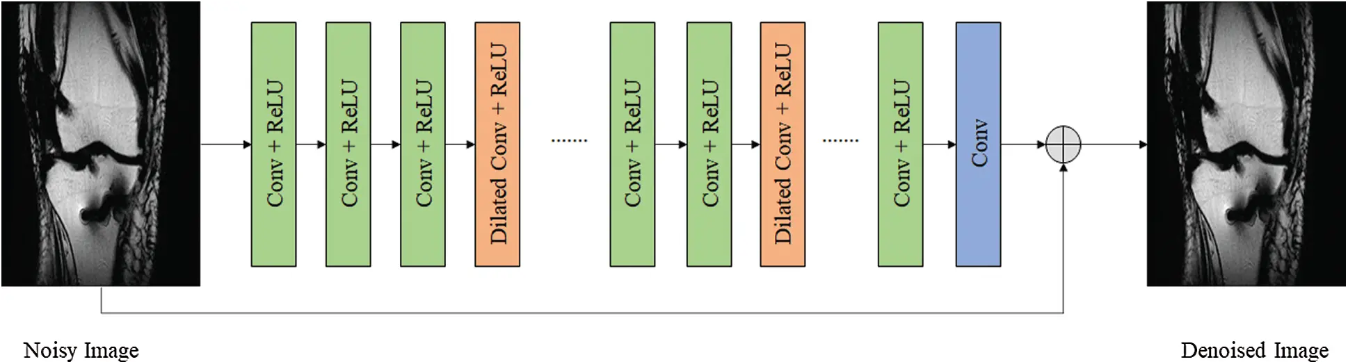 Denoising Medical Images Using Deep Learning in IoT Environment
