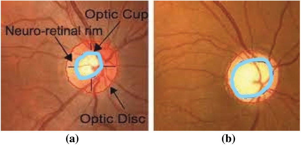 Classification of Glaucoma in Retinal Images Using EfficientnetB4 Deep ...