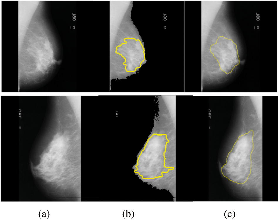 Performance Analysis of Breast Cancer Detection Method Using ANFIS ...