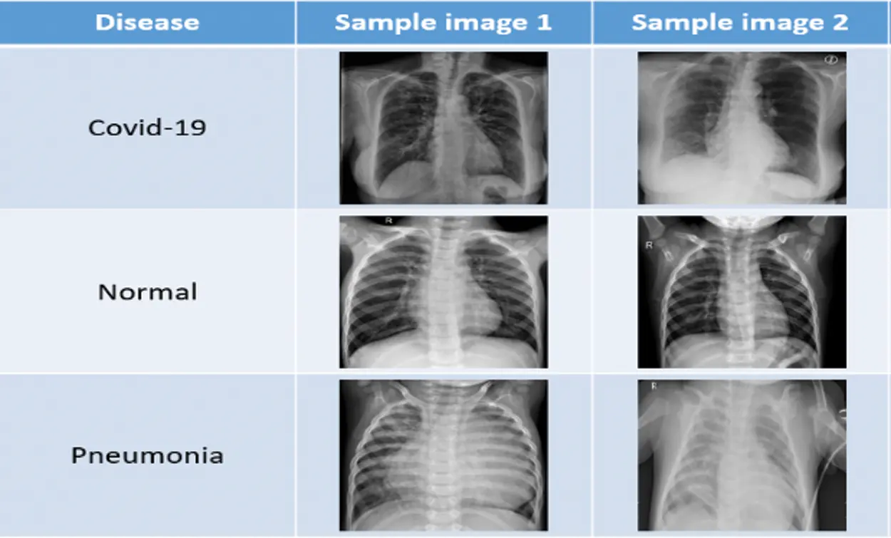 Detection of COVID-19 and Pneumonia Using Deep Convolutional Neural Network