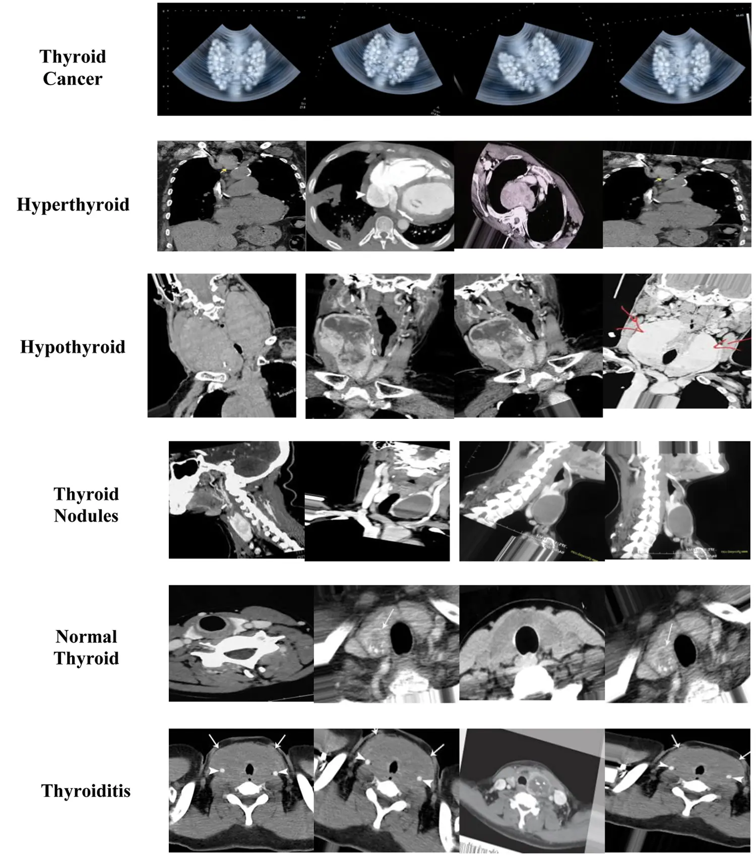 A Novel Technique for Detecting Various Thyroid Diseases Using Deep ...