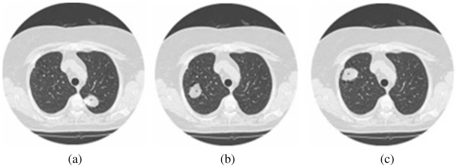 Lung Nodule Detection Based on YOLOv3 Deep Learning with Limited Datasets
