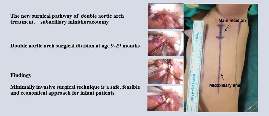 Minimally Invasive Surgical Technique in Double Aortic Arch with Distal Atretic Left-Side in Infant: From a Single-Surgeon Clinical Experience