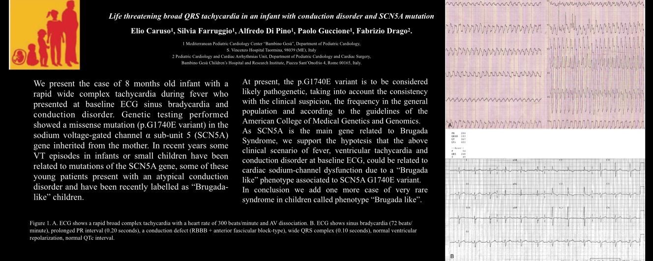 Life Threatening Broad QRS Tachycardia in an Infant with Conduction Disorder and <i>SCN5A</i> Mutation