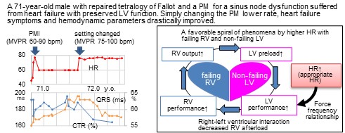 Appropriate Heart Rate in a Patient with Repaired Tetralogy of Fallot