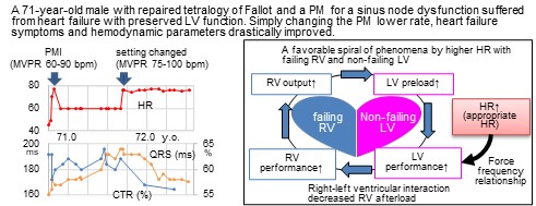 Appropriate Heart Rate in a Patient with Repaired Tetralogy of Fallot