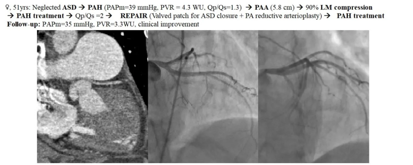 “Treat-Repair-Treat”: Management of Left Main Coronary Compression by a Pulmonary Artery Aneurysm in a Patient with Atrial Septal Defect and Significant Pulmonary Hypertension