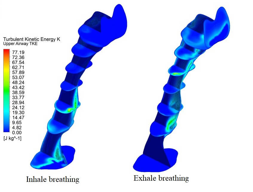 Turbulent Kinetic Energy of Flow during Inhale and Exhale to Characterize the Severity of Obstructive Sleep Apnea Patient