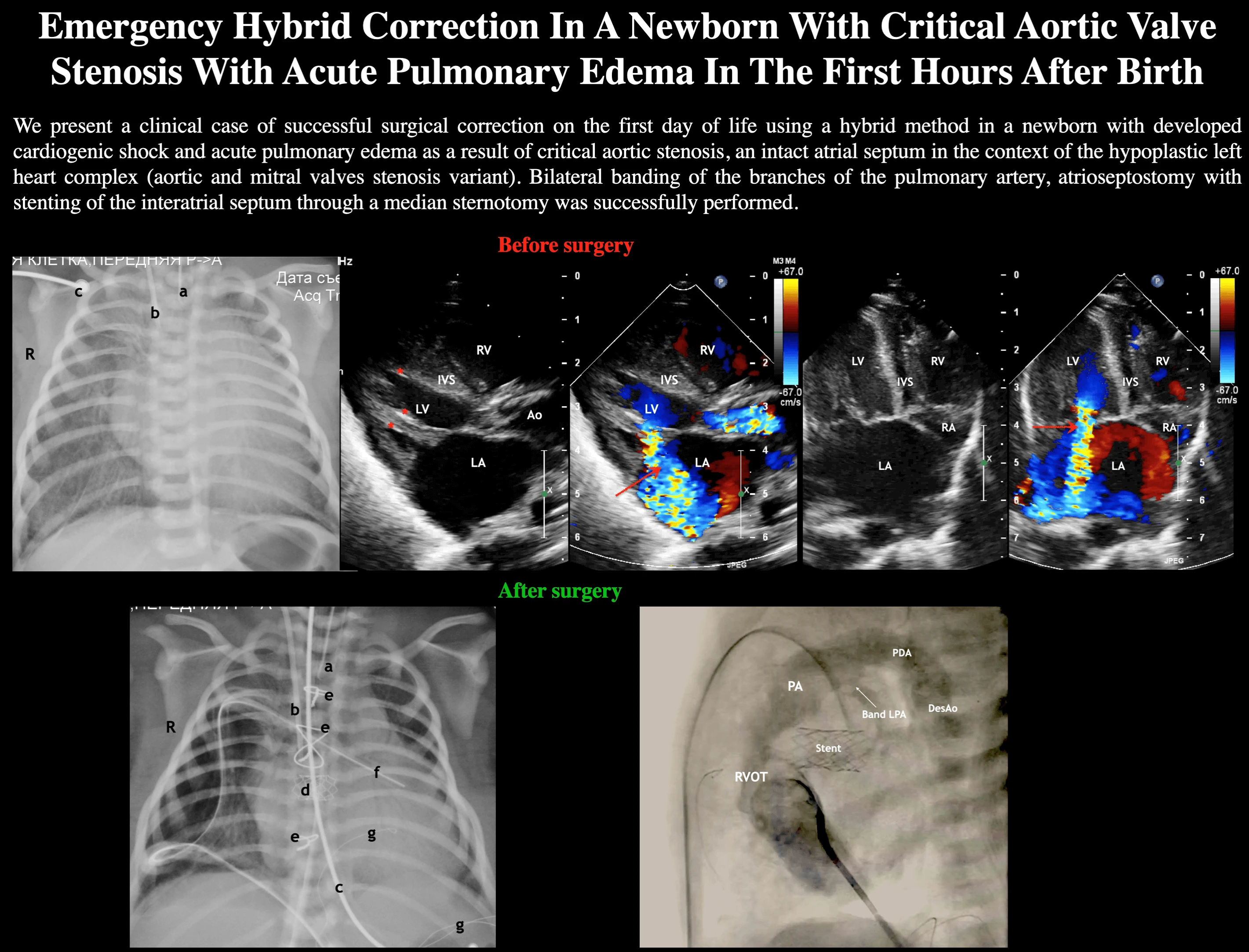 Emergency Hybrid Correction in a Newborn with Critical Aortic Valve Stenosis with Acute Pulmonary Edema in the First Hour after Birth