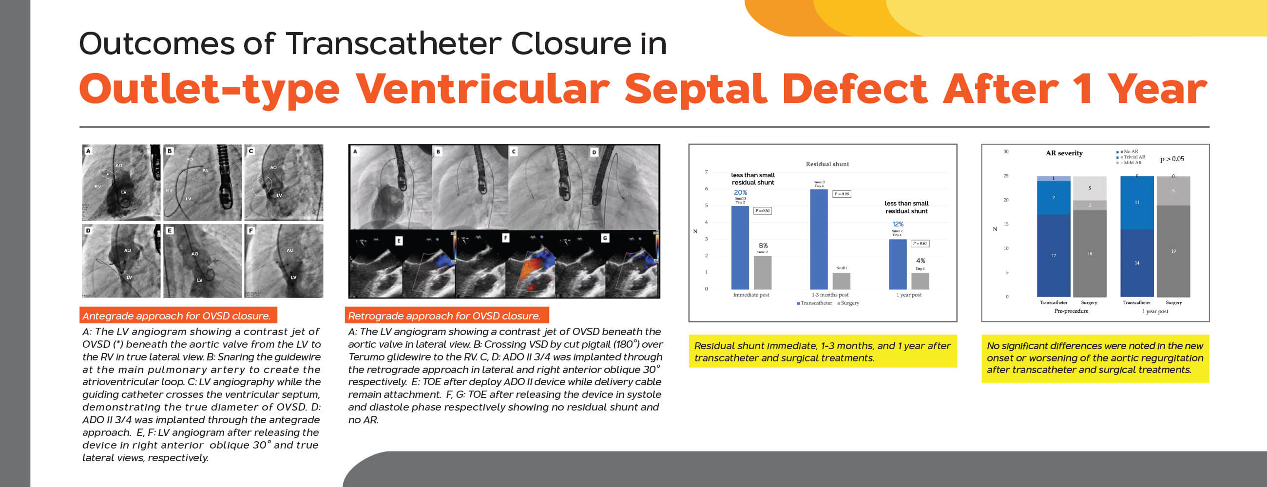 Outcomes of Transcatheter Closure in Outlet-Type Ventricular Septal Defect after 1 Year