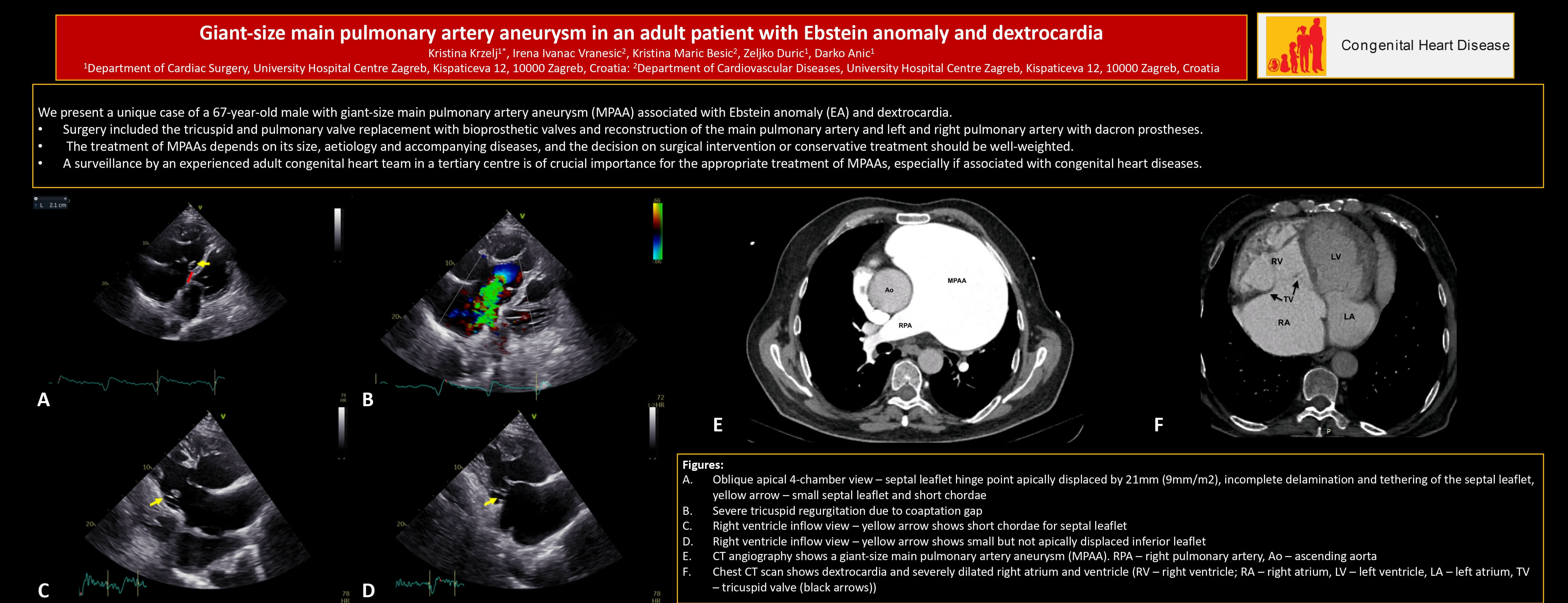Giant-Size Main Pulmonary Artery Aneurysm in an Adult Patient with Ebstein Anomaly and Dextrocardia