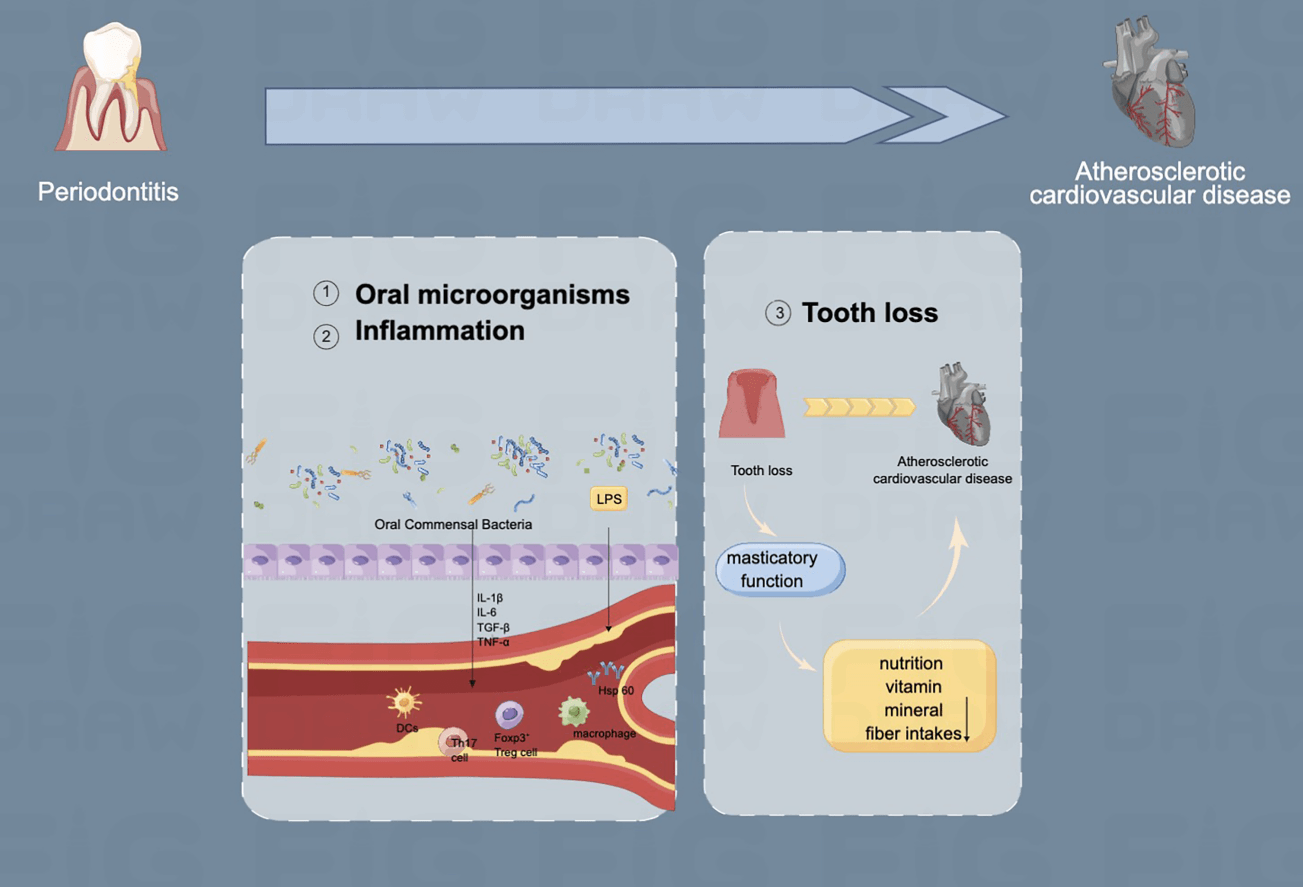 The role of periodontal disease in atherosclerotic cardiovascular disease