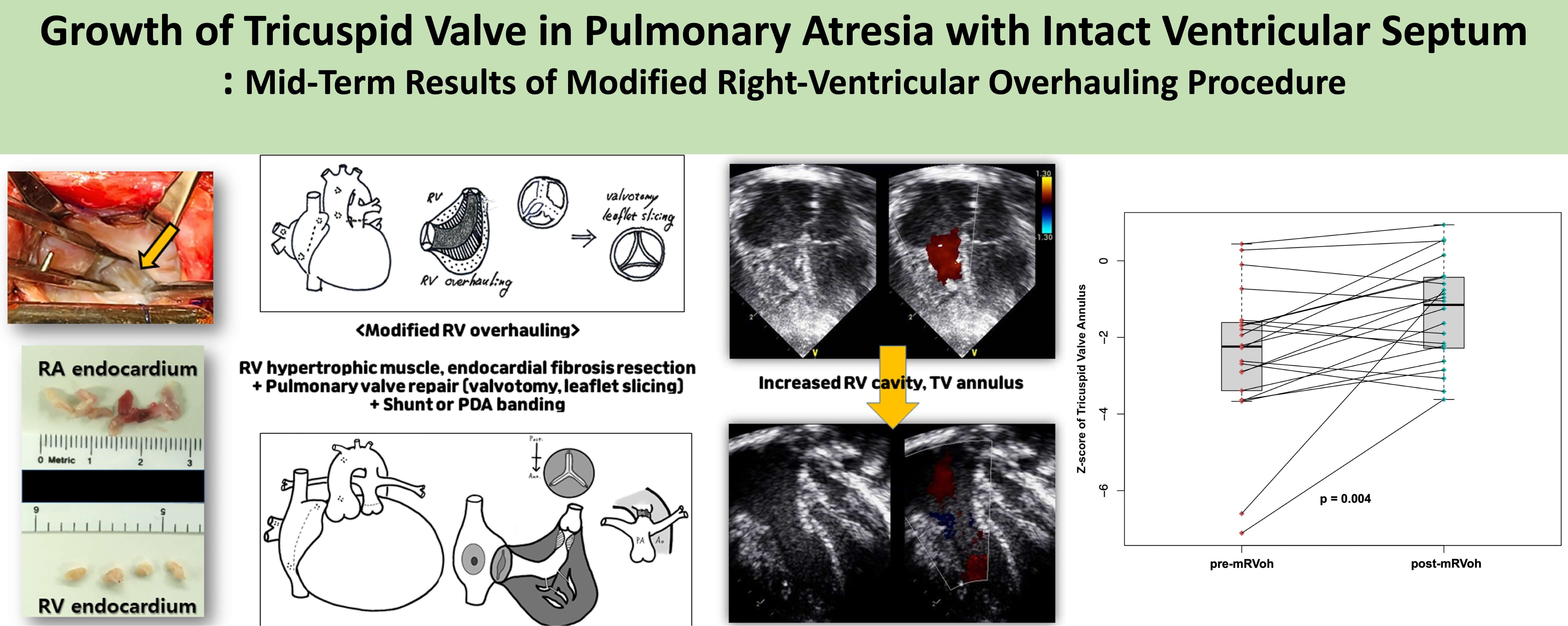 Role of Surgery on Growth of Tricuspid Valve in Pulmonary Atresia with Intact Ventricular Septum: Mid-Term Results of Modified Right-Ventricular Overhauling Procedure