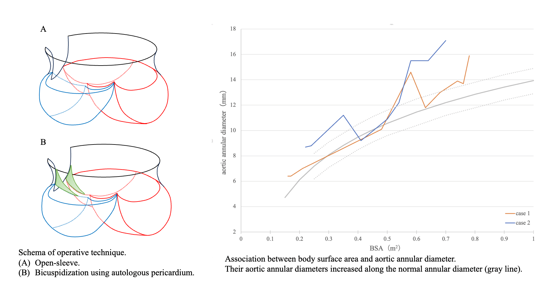 Bicuspidization Using the Open-Sleeve Technique for Congenital Aortic Stenosis during Infancy