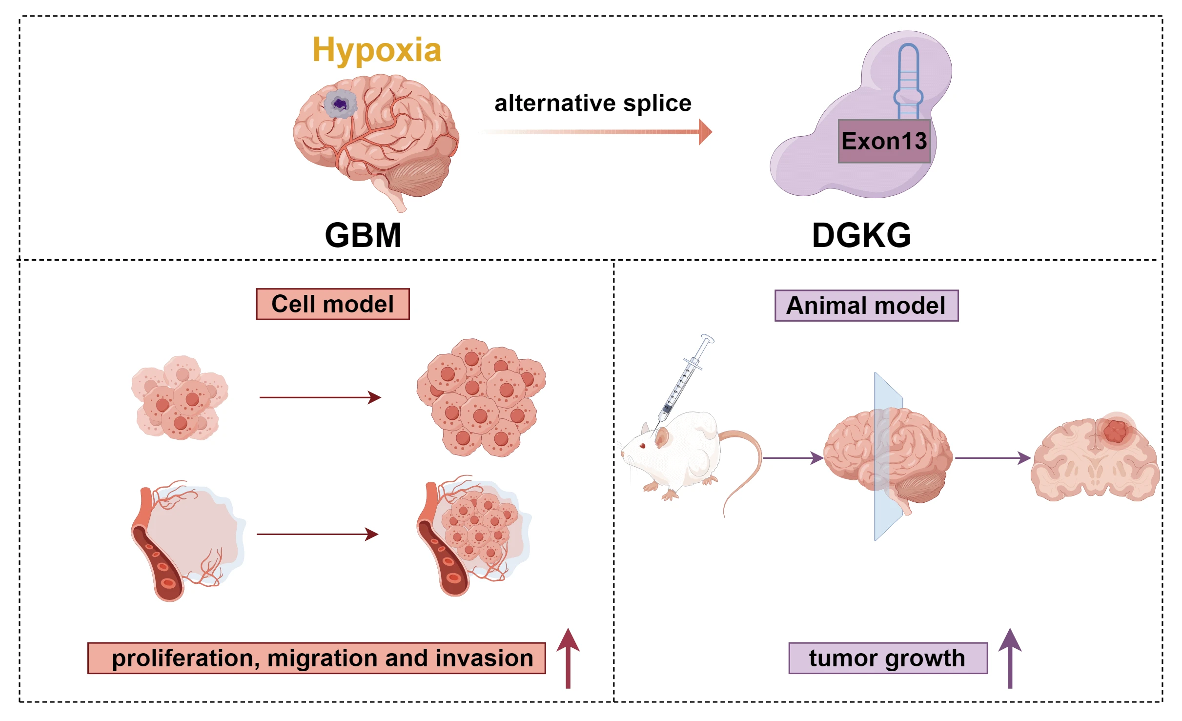 The alternatively spliced diacylglycerol kinase gamma-Δ exon13 transcript generated under hypoxia promotes glioblastoma progression