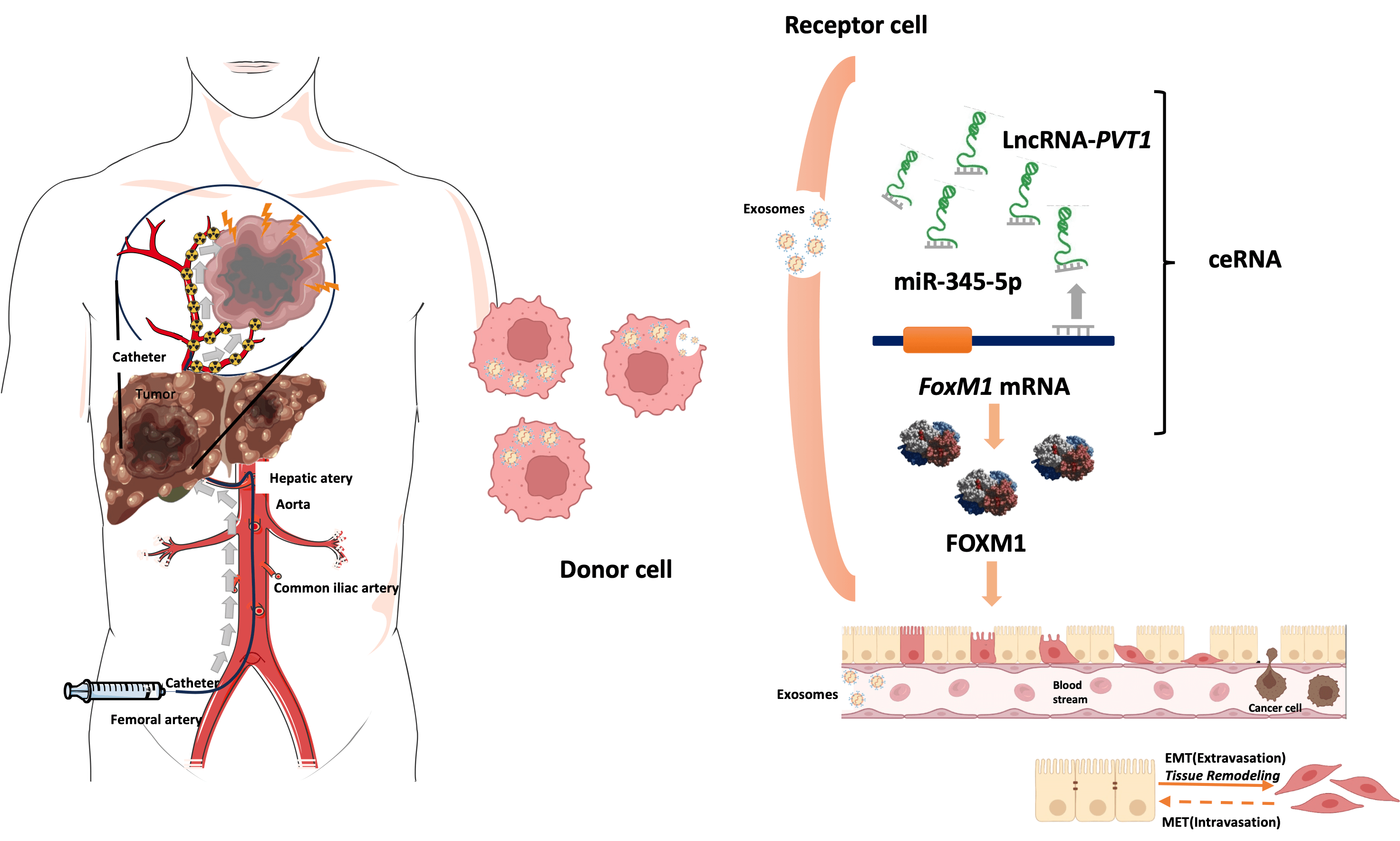 Hypoxia-induced exosomal lncRNA-PVT1 as a biomarker and mediator of EMT in hepatocellular carcinoma