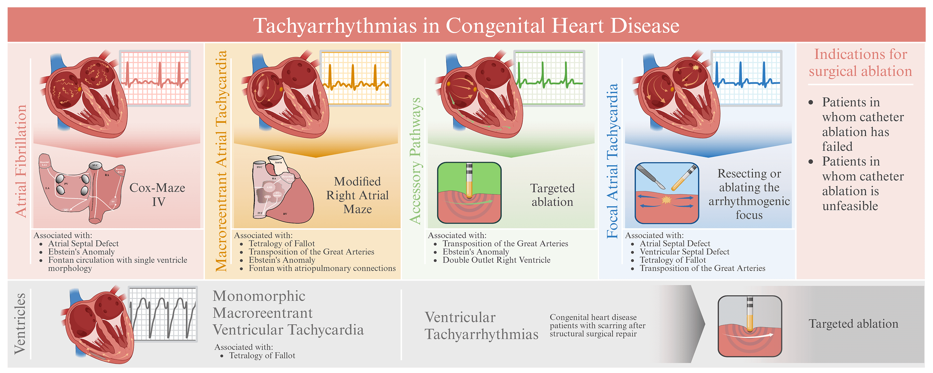 Surgical Ablation in Congenital Heart Disease: Advances in Techniques and Clinical Outcomes