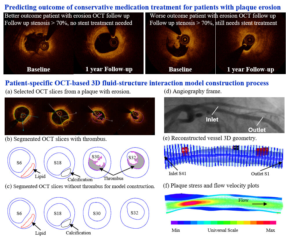Computational Modeling to Predict Conservative Treatment Outcome for Patients with Plaque Erosion: An OCT-Based Patient-Specific FSI Modeling Study
