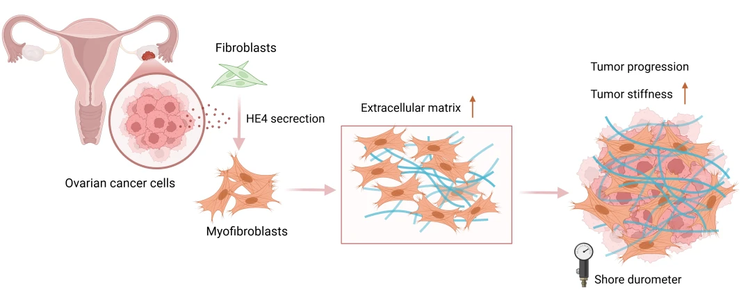 HE4 Might Participate in Extracellular Matrix Remodeling in Ovarian Cancer via Activation of Fibroblasts