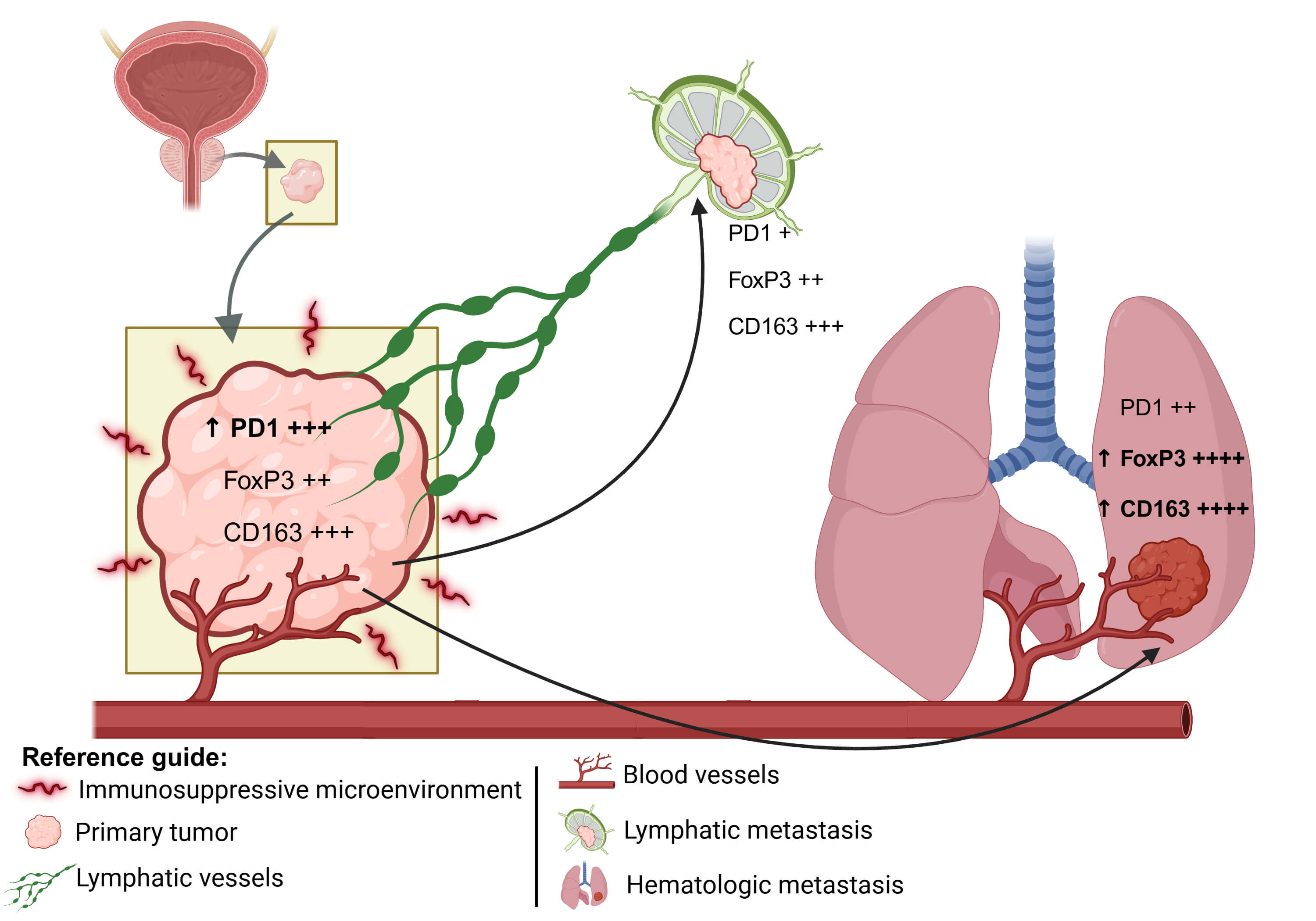 Diverse PD-1, CD163, and FOXP3 Profiles in Primary and Metastatic Microenvironments of Prostate Cancer