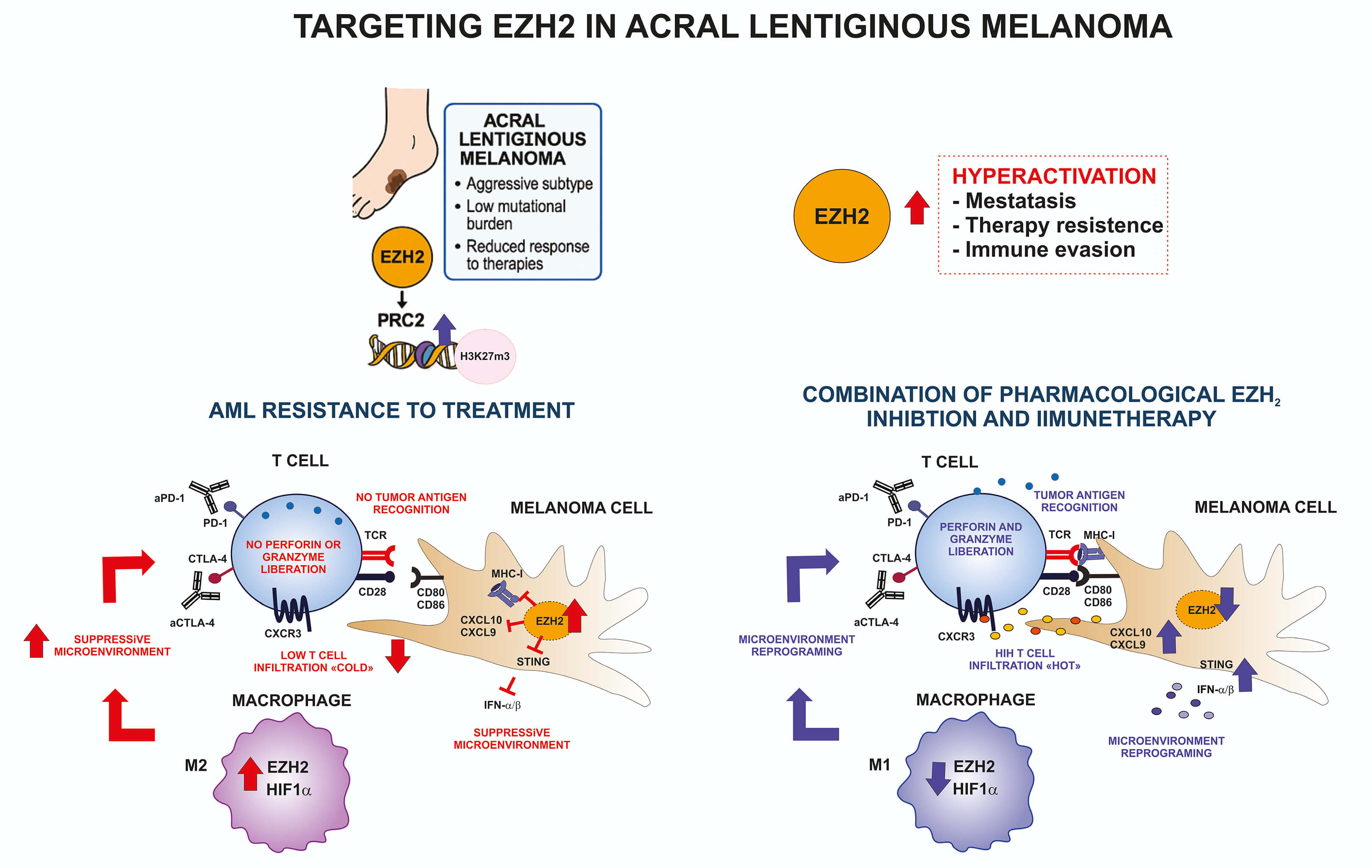 EZH2 in Acral Lentiginous Melanoma: Molecular, Epigenetic, and Therapeutic Perspectives