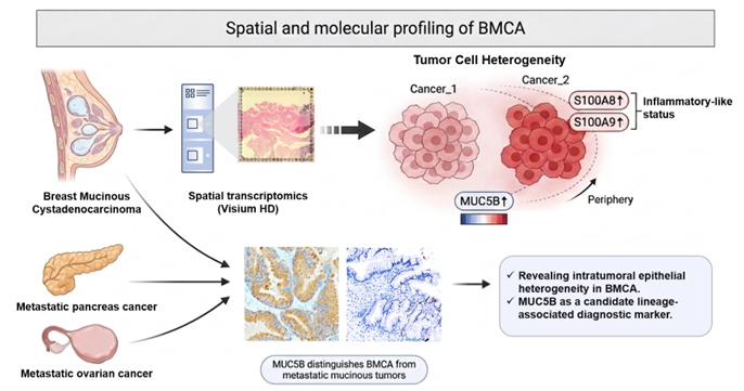 Spatial Transcriptomic Profiling Identifies Epithelial Heterogeneity and a Potential Lineage-Associated Marker in Breast Mucinous Cystadenocarcinoma